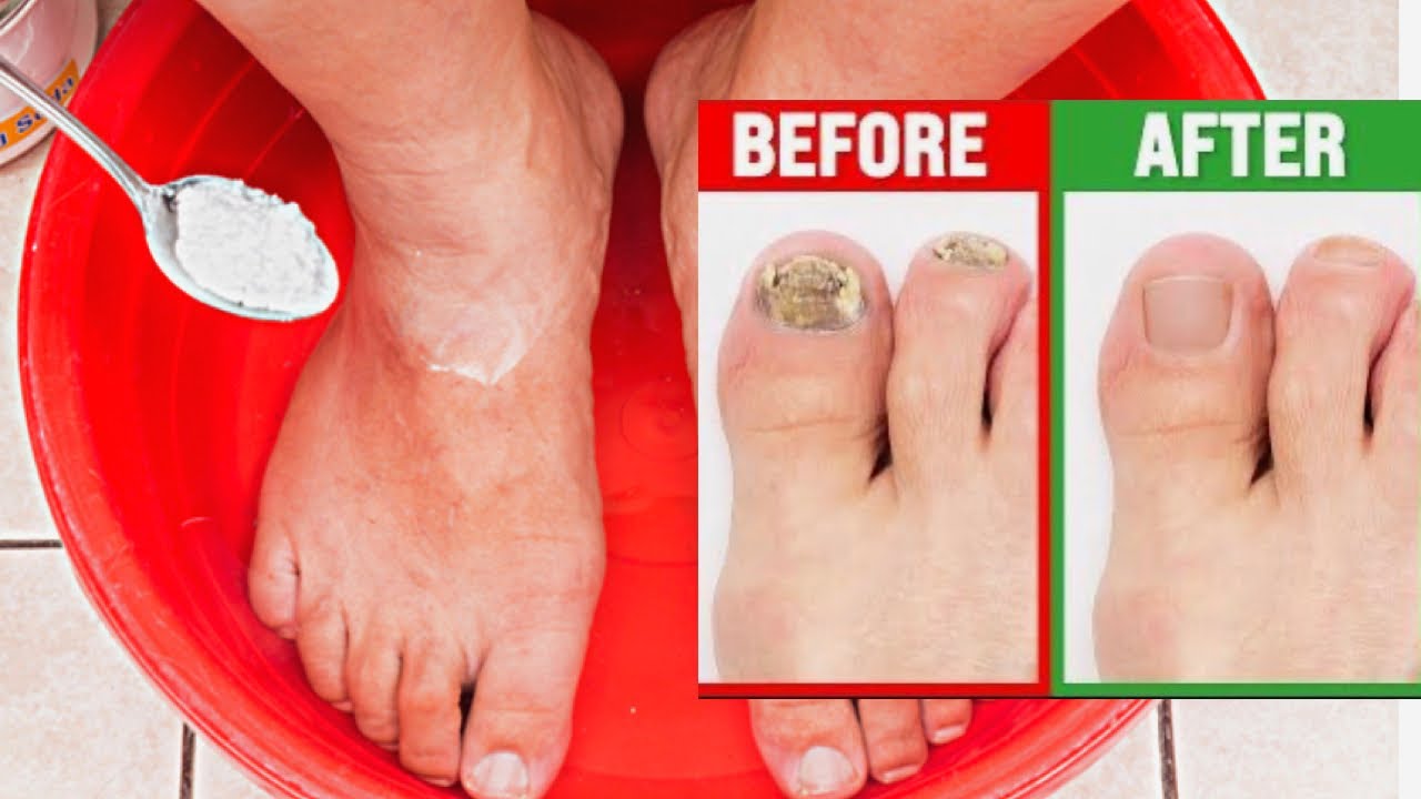 Nail Fungus Removal 100 Natural Treatment for Toenail Fungus with